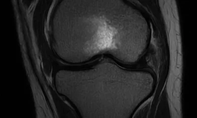 radiografia de un edema óseo