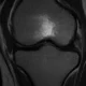 radiografia de un edema óseo