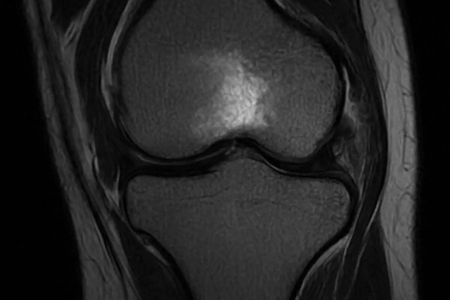 radiografia de un edema óseo
