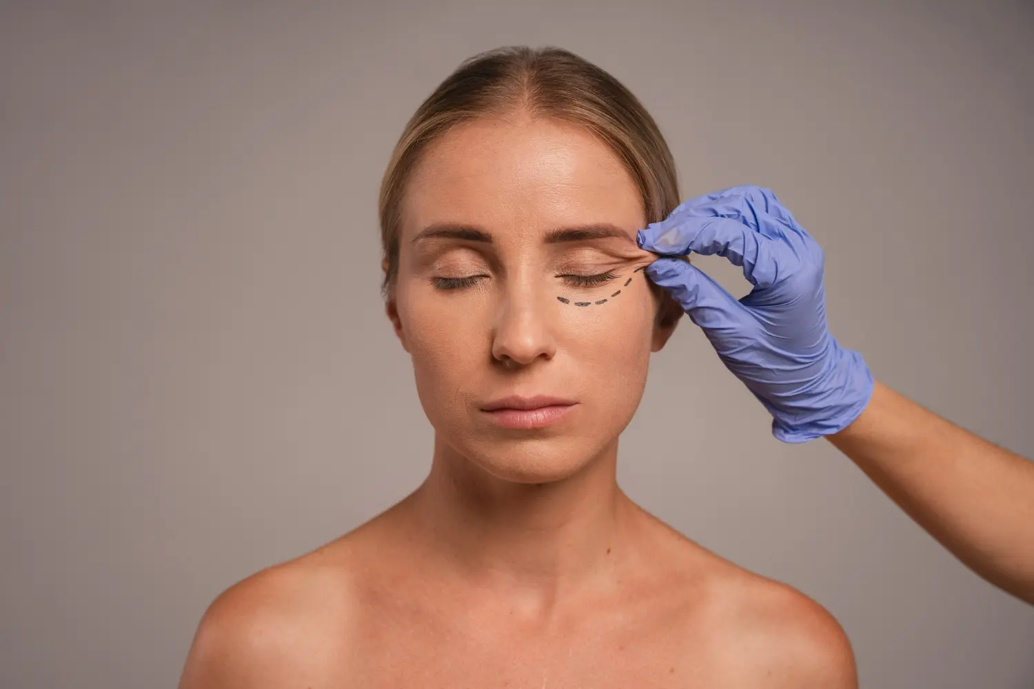 Blefaroplastia mal hechas