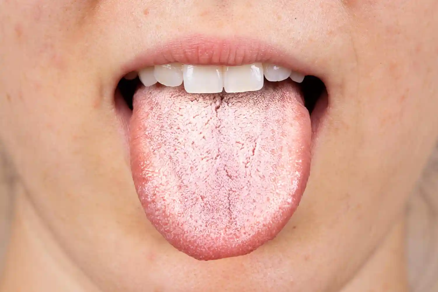 Por qué tengo la lengua blanca