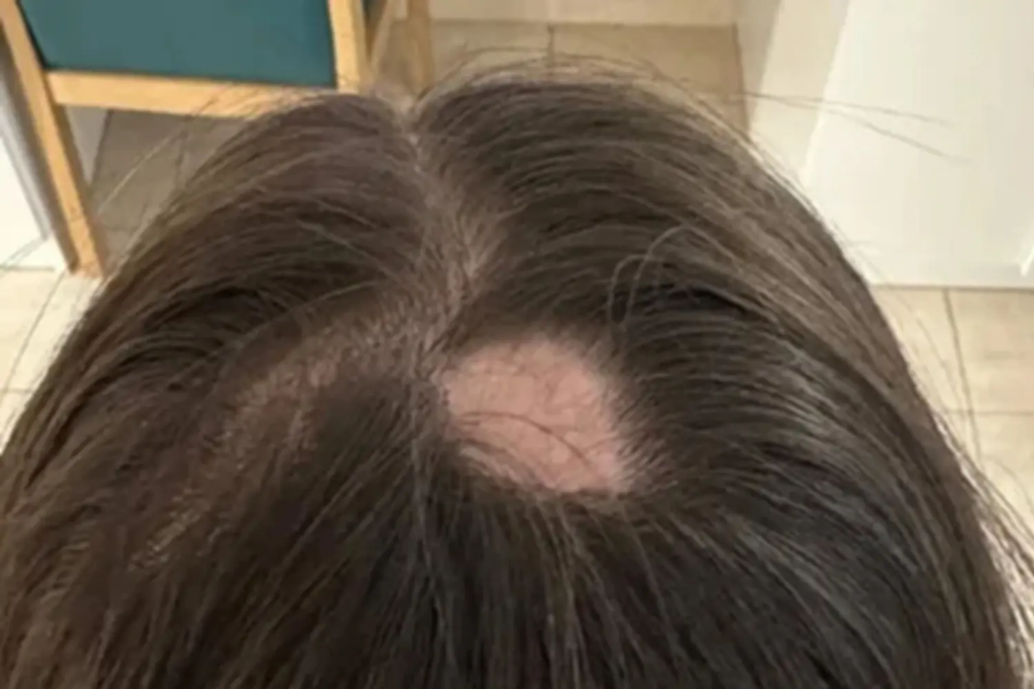 alopecia areada de alexia rivas