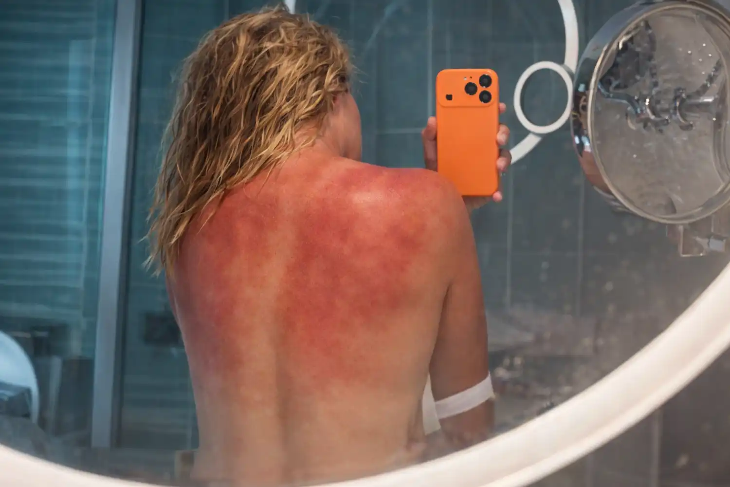 Renata Zarazúa muestra espalda quemada