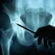 muerte por operacion de cadera
