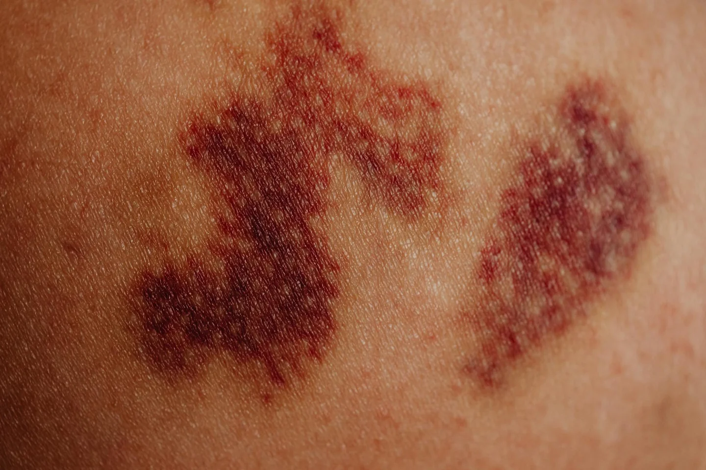 Primer plano de piernas con moretones, útil para ilustrar porque salen moretones sin golpes en las piernas.