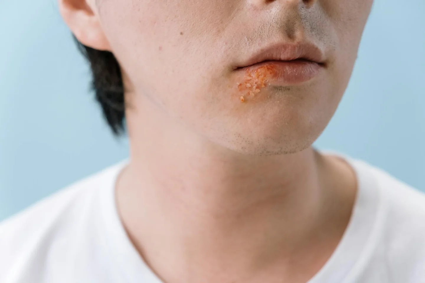 Imagen de un labio con herpes labial para ilustrar porque sale fiebre en el labio