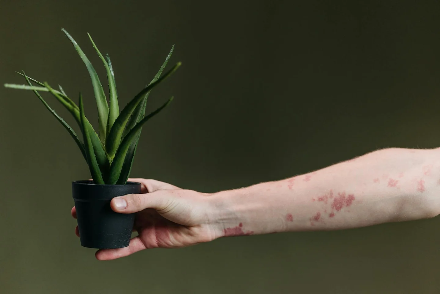 Imagen de una persona con red skin rash para ilustrar porque salen manchas en la piel rojas en un artículo sobre causas y señales de alerta.
