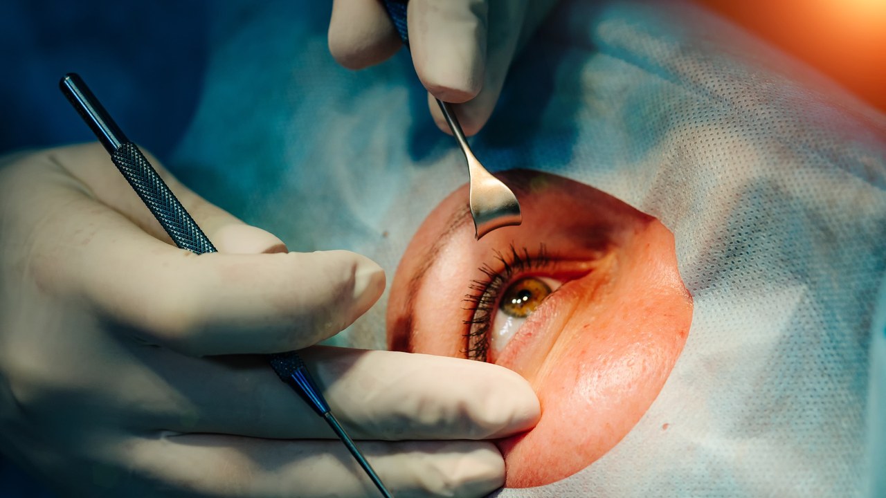Corrección láser para visión. Cirugía oftalmológica para ojo — Felipe VI, operado de cataratas a los 58: qué es y por qué es la cirugía ocular más común
